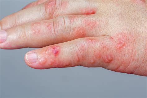 Shingles Zoster Or Herpes Zoster Symptoms On Arm Stock Photo - Download Image Now - Shingles ...