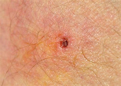 What Does A Tick Bite Look Like Health | Images and Photos finder