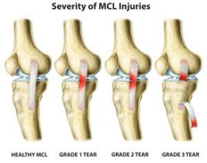 Common Questions About MCL Knee Sprains