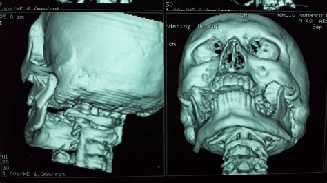 radiology ENT, Maxillofacial, Head and neck, neurosurgery, Dentology: subcondylar fracture of ...