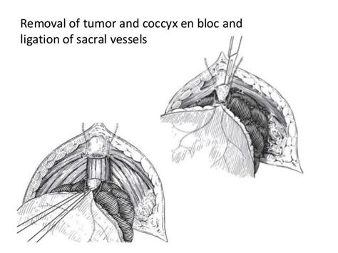 sacrococcygeal teratoma