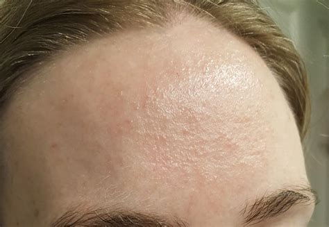 How I Cleared My Tiny Bumps On Forehead Once For All - vrogue.co