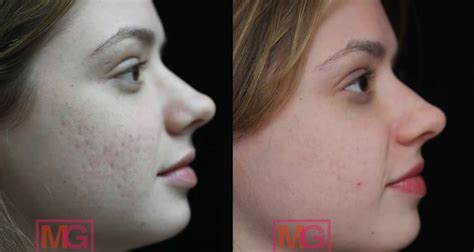 Here's How Dermal Fillers Can Get Rid Of Your Acne Scars