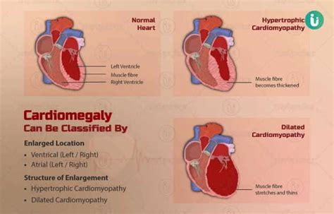 Enlarged Heart symptoms, causes, treatment, medicine, prevention, diagnosis