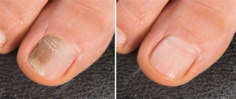 Premium Photo | Big toe with nail affected by onychomycosis closeup of before and after ...