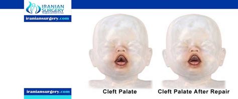 What to expect after cleft palate surgery - Iranian Surgery