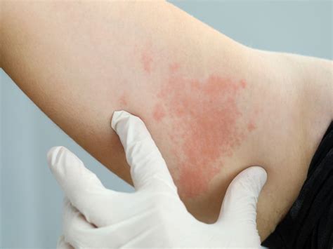 Why Do Hives Occur with HIV?