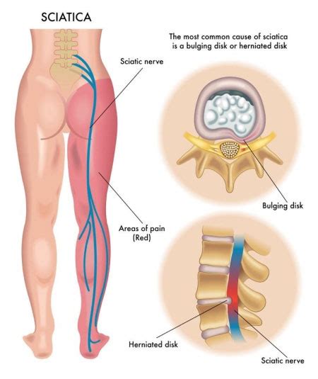 What Is Sciatica & How Is It Treated? | Center for Comprehensive Spine Care