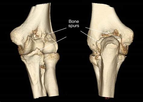 Did you know that the elbow joint is particularly at risk for stiffness ...