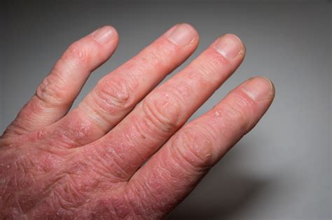 Psoriatic Arthritis (PsA): Symptoms, Causes & Treatment Options - Page ...