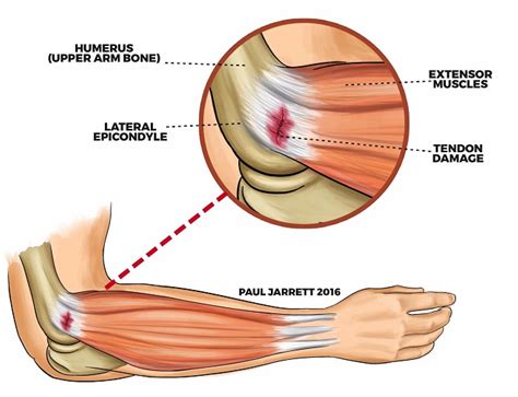 tennis elbow คือ | Rehab Care Clinic