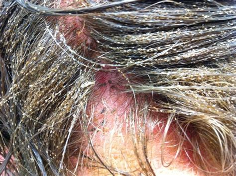 The Lice Infested Child: Warning Signs That Can Not Be Ignored