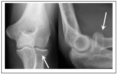 Radial Head / Neck Fracture — Chelsea and Westminster Hospital NHS Foundation Trust