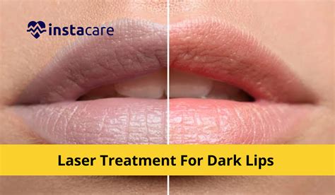 Laser Treatment For Dark Lips - All You Need To Know