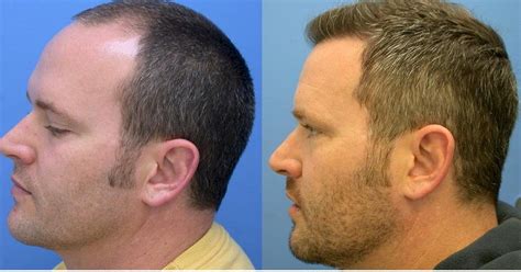 Best hair transplant Los Angeles - Revive hair restoration: Best Hair ...