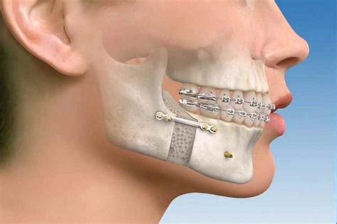 Jaw Fracture – Dental clinic in Jamnagar