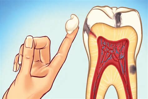 Toothache Symptoms, Causes, and Treatments | Dental Depot