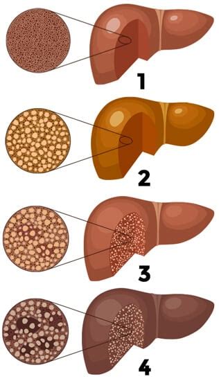 ¿Qué es la esteatosis hepática o enfermedad del hígado graso?