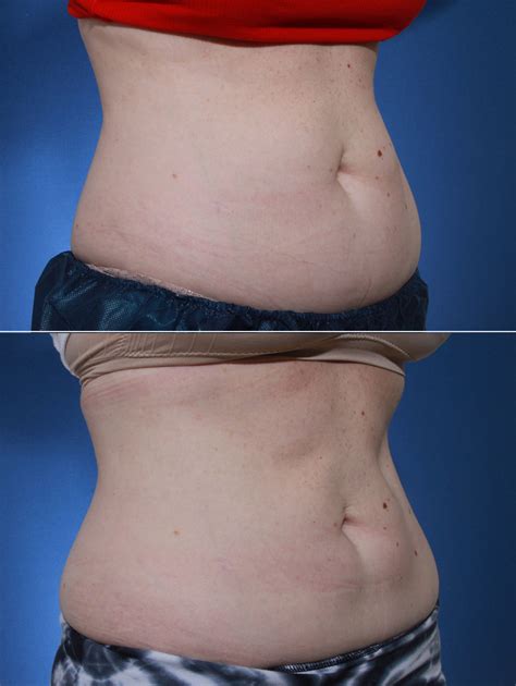 coolsculpting-stomach