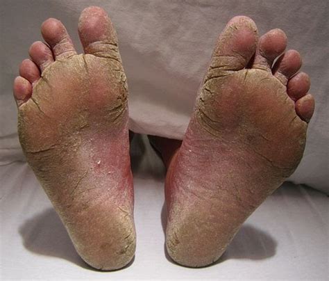 Tinea Pedis- Causes, Symptoms, and Diagnosis Explained - Dream Health