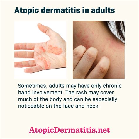 Atopic Dermatitis Face Treatment - Doctor Heck