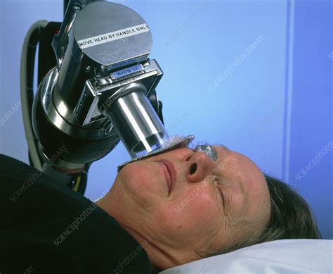 Radiotherapy treatment of skin cancer on cheek - Stock Image - M705/0133 - Science Photo Library