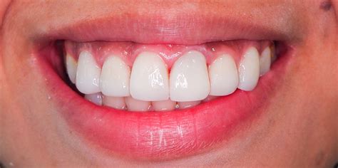 Composite Veneers Philippines