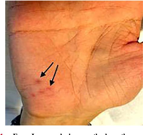 Pasteurella Multocida Human Infection