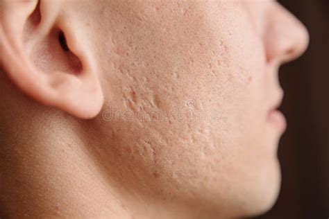 Acne scars on the face stock image. Image of health - 180490179