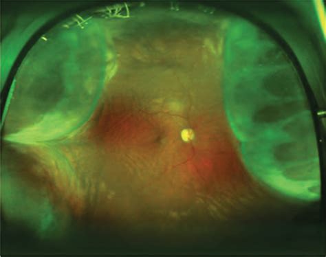 Choroidal Hemorrhage