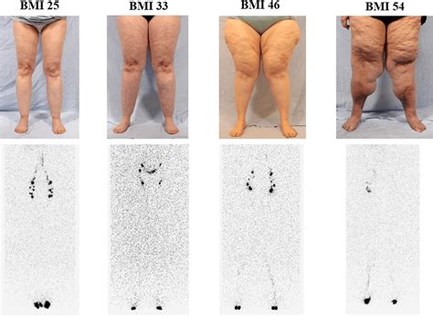 Elevated BMI negatively affects lymphatic function in patients with... | Download Scientific Diagram