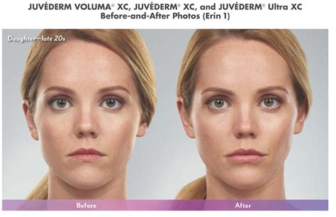 Juvederm Cheek Fillers Before And After - All You Need Infos