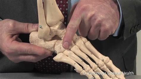 Osteoarthritis of the Mid-foot - YouTube