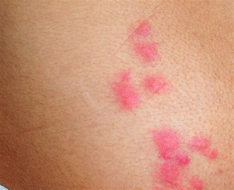 Different Types Of Bed Bug Bites