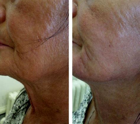 Laser Face Lift In San Diego Before And After » Facelift: Info, Prices, Photos, Reviews, Q&A