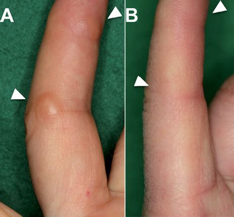 Subcutaneous Nodules Rheumatoid Arthritis