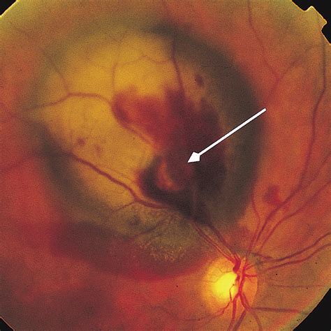 Subretinal Hemorrhage From Retinal Arterial Macroaneurysm Simulating Malignancy | Oncology ...