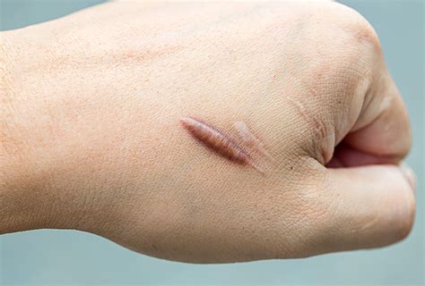 How to Prevent and Treat Keloid Scars - eMediHealth