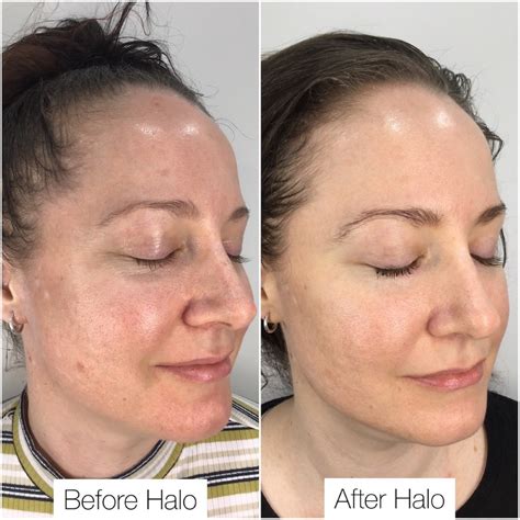 Aprender acerca 59+ imagen halo skin treatment before and after - Viaterra.mx