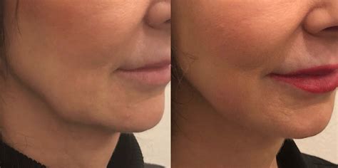 Kybella for Jowls: a game changer | U Med Spa, Plano TX