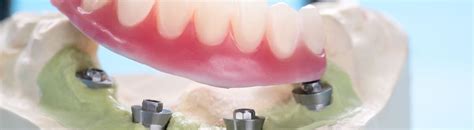 How Many Dental Implants Needed? Implant Fixed Bridge, Implant Denture