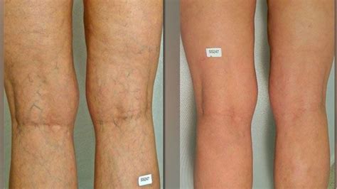 Varicose Vein Makeup For Legs | Makeupview.co