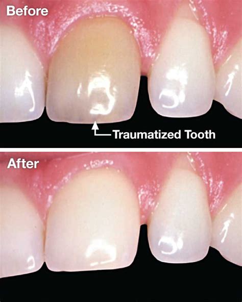 Whitening Traumatized Teeth | Stanley R. Beard, D.M.D., FAGD | Jackson Alabama