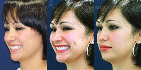 Dimple Creation | Plastic Surgery