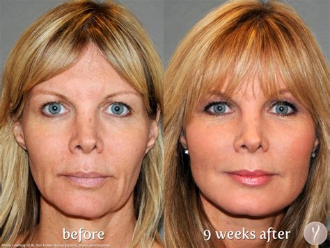 Y-Lift-Liquid Facelift Procedure | Columbus, OH | Dr. Mantor's Wrinkle and Weight Solutions LLC