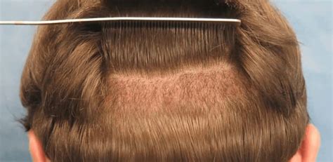 Hair Transplant Success Rate | ClinicExpert Services