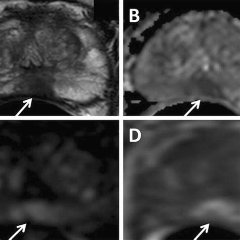 Multi-parametric MRI with A T2-weighted B ADC map C DCE and D... | Download Scientific Diagram