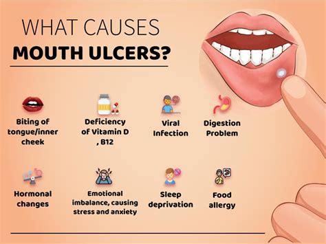 Tongue Ulcer: How To Identify, Symptoms, Treatment, And, 44% OFF