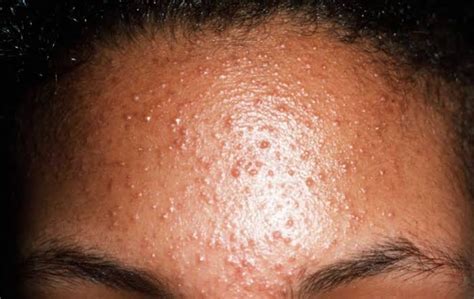 Malassezia folliculitis. Malassezia folliculitis, commonly known… | by ...