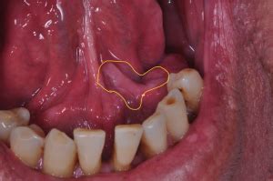 Oral Cancer Under Tongue